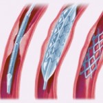 angioplasty